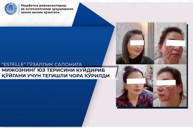 В Ташкенте салон красоты Estelle обвинён в причинении тяжёлого химического ожога клиентке